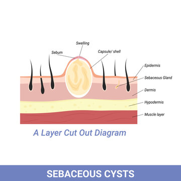 Sebaceous Cyst or other skin and follicle problems illustration