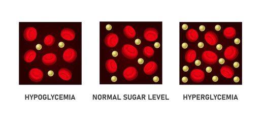 Glucose Blood Sugar Level Set. Hypoglycemia and Hyperglycemia Icons. Vector