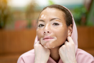 Black african american woman with vitiligo pigmentation skin problem indoor dressed pink hoodie