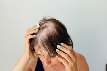 Hair loss in the form of alopecia areata. Bald head of a woman. Hair thinning after covid. Bald...