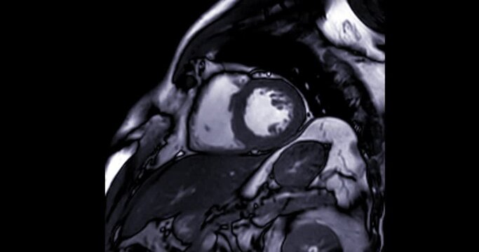 MRI heart or Cardiac MRI ( magnetic resonance imaging ) of heart  showing heart beating for detecting heart disease.