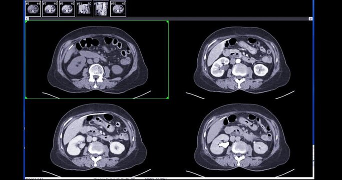 anatomy, asthma, background, cancer, cardiac, chest, computed, computed tomography, cough, covid-19, covid19, ct, ct chest, ct lung, ct scanner, diagnosis, diagnostic, disease, dyspnea, enhance, film,