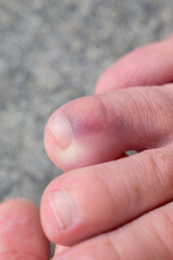 Close up detail of a broken toe of a senior man