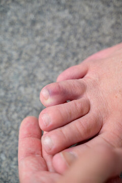 Close up detail of a broken toe of a senior man