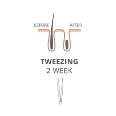 Tweezing hair removal method result after two weeks, flat vector illustration.