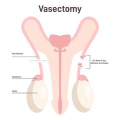 Vasectomy. Surgical procedure for male sterilization. Male reproductive