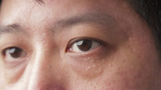 Asian men have dry eyes. concept of eye disease Eye health check. Chronic glaucoma in a 40-year-old man