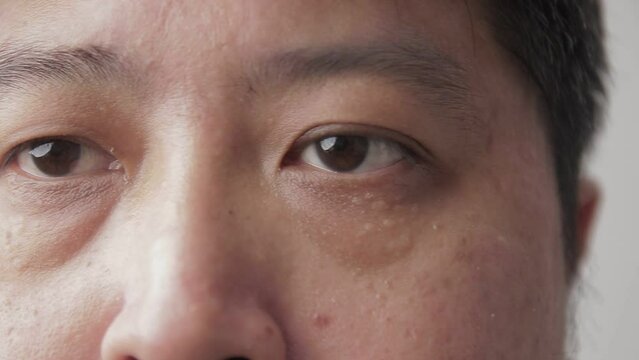 Asian men have dry eyes. concept of eye disease Eye health check. Chronic glaucoma in people aged 40 years. Skin disease, acne problems.