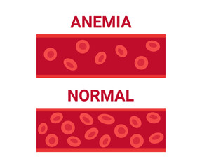 Normal and anemia blood in vessel comparison, number circulation cells erythrocyte. Hemoglobin low level, iron deficiency anemia. Disease anemic blood cells. Health problem. Vector illustration - obrazy, fototapety, plakaty