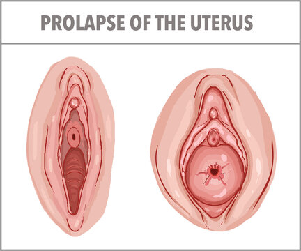 Prolapse of the uterus. gynecology vector illustration