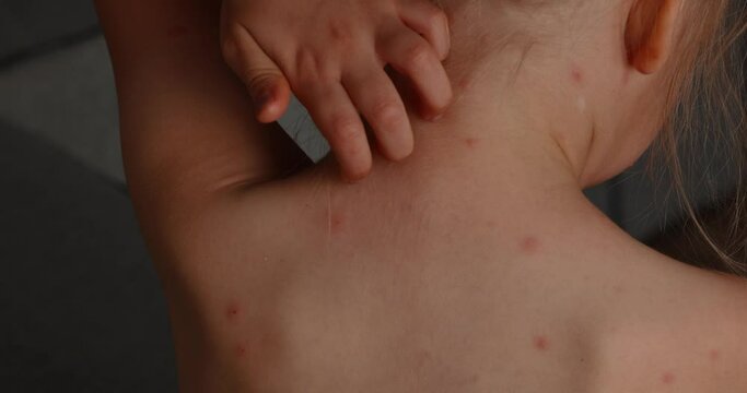 Girl itches, skin rashes. Five-year-old girl with chickenpox, measles, Monkeypox virus.