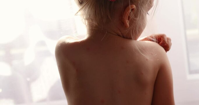 Girl itches, skin rashes. Five-year-old girl with chickenpox, measles, Monkeypox virus.