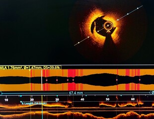Intravascular imaging Optical Coherence Tomography (OCT) shown dissection in coronary artery. - obrazy, fototapety, plakaty