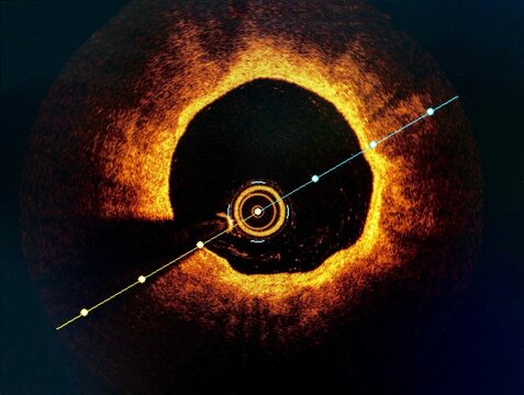 Intravascular Imaging Optical Coherence Tomography (OCT) During Cardiac Catheterization.