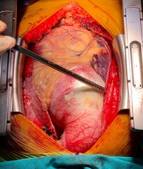 open heart surgery in patient with ascending aortic aneurysm. 