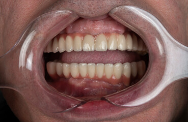 Close up of man cavity protected by retractor showing perfect teeth.implants and pressed ceramic crowns