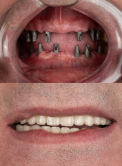 before and after pictures of dental implants and press ceramic crowns