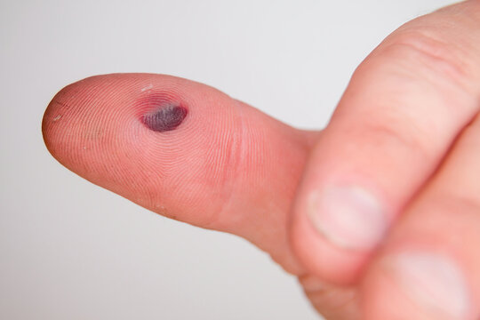 Blood blister under the thumb skin. Caucasian young man finger on white background.