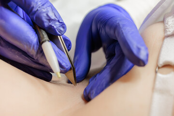 macro photography working doctor electrolysis using an electrode and tweezers permanent hair...