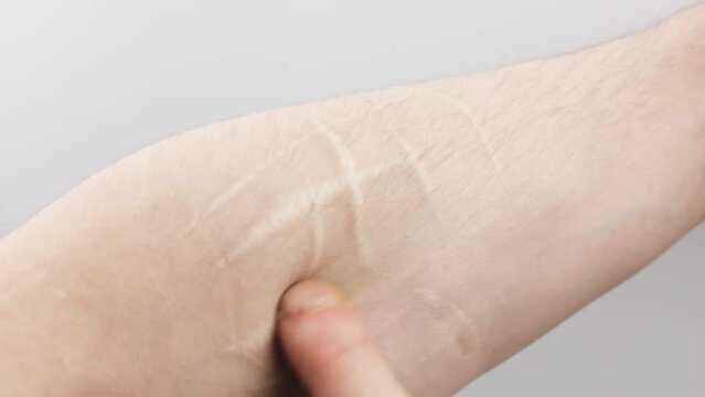 Scars from cuts on the arm. suicide.Cut marks on arms.