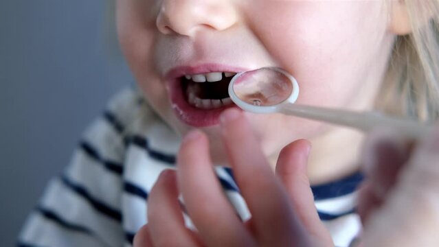 dentist, doctor examines oral cavity of small patient, uses mouth mirror, closeup baby teeth child, concept pediatric dentistry, dental treatment, correction of occlusion, oral care, caries prevention