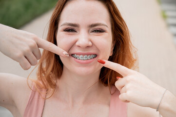 Young red-haired woman with braces on her teeth point to a smile outdoors in summer