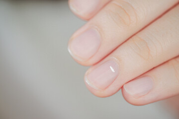 White spots on finger nails called leukonychia reveal the emergence of health problems.