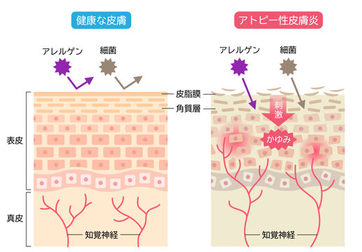 アトピー性皮膚炎と健康な皮膚　肌細胞と断面図