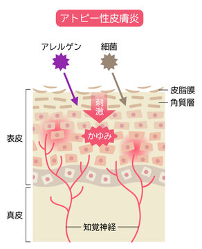 アトピー性皮膚炎のしくみ　肌細胞と断面図