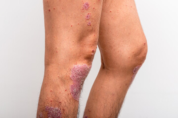 Psoriasis is that knee on white background.