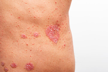 Psoriasis is that back on white background.