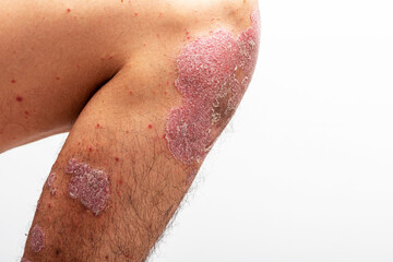 Psoriasis is that knee on white background.