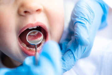 Closeup open mouth child and mirror in dentists hands in blue gloves checkup examine treating teeth...