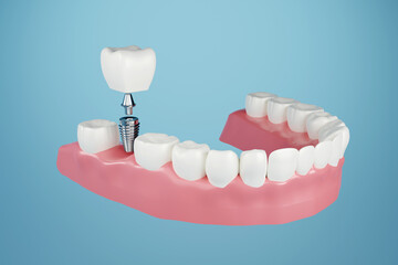 Dental implant, Fix missing teeth with metal screw, teeth crown treatment 3D rendering
