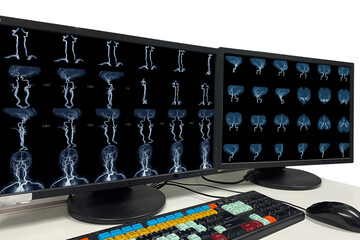  MRA brian scan image of a recent traumatic brain injury patient showing brain contusion and...