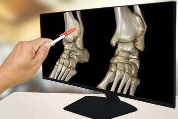 The results of x-ray images of the ankle and found distal tibia bone abnormalities (distal...