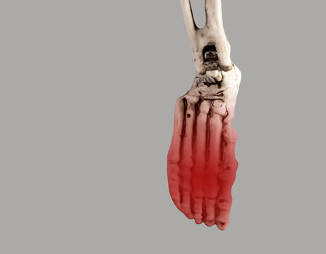 Human skeleton foot with red point at forefoot. Injury, excessive physical activity, ill-fitting shoes consequences. Pain, swelling, redness. Health problems, anatomy concept. High quality photo