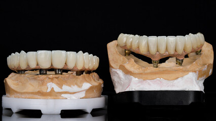the process of manufacturing a dental beam from a beam and crowns of the upper and lower jaws on...