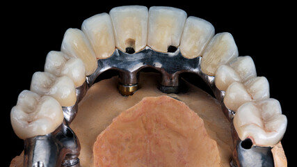 excellent morphology and relief of ceramic teeth on the prosthesis of the upper jaw on a black background © Dental Pro Content