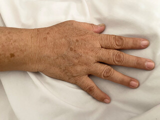 Old female hand full of freckles. Asia woman skin tone.