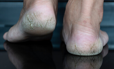 Close up cracked heel further deep cracks and dry flaky skin