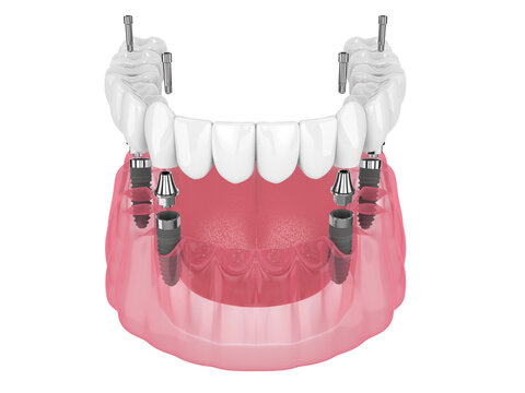 Mandibular prosthesis all on 4 system supported by implants
