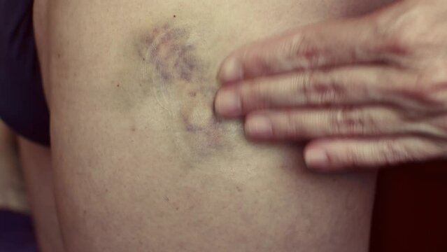 A woman's hand smears cream on a large bruise on her leg. Close-up.