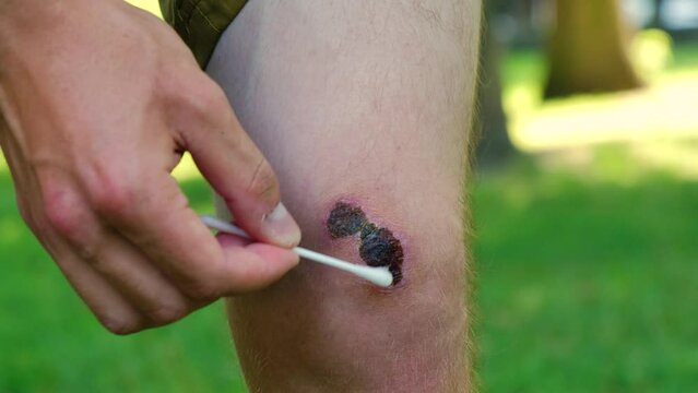 Man using cotton swap to apply hydrogen peroxide hurt joint, suffering from bruised knee injury. Wounded scraped leg with hematoma. Painful accident, dried blood, desinfection