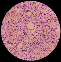 Granulomatous inflammation with tuberculosis. Microscopic show fibrofatty tissue, acute and chronic inflammatory cells and stellate granuloma. Axillary abscess histology. - obrazy, fototapety, plakaty