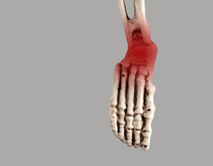 Human skeleton foot with red point at heel and ankle. Injury, plantar fasciitis, tendinitis...