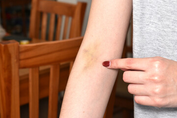 young woman with a hematoma on her arm