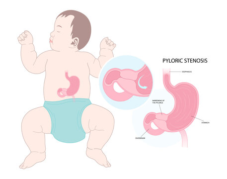 newborn with enlarged Pyloric stenosis in pylorus