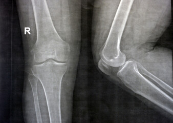 Plain X ray of the right knee shows apparent joint osteoarthritis according to Kellgren and...