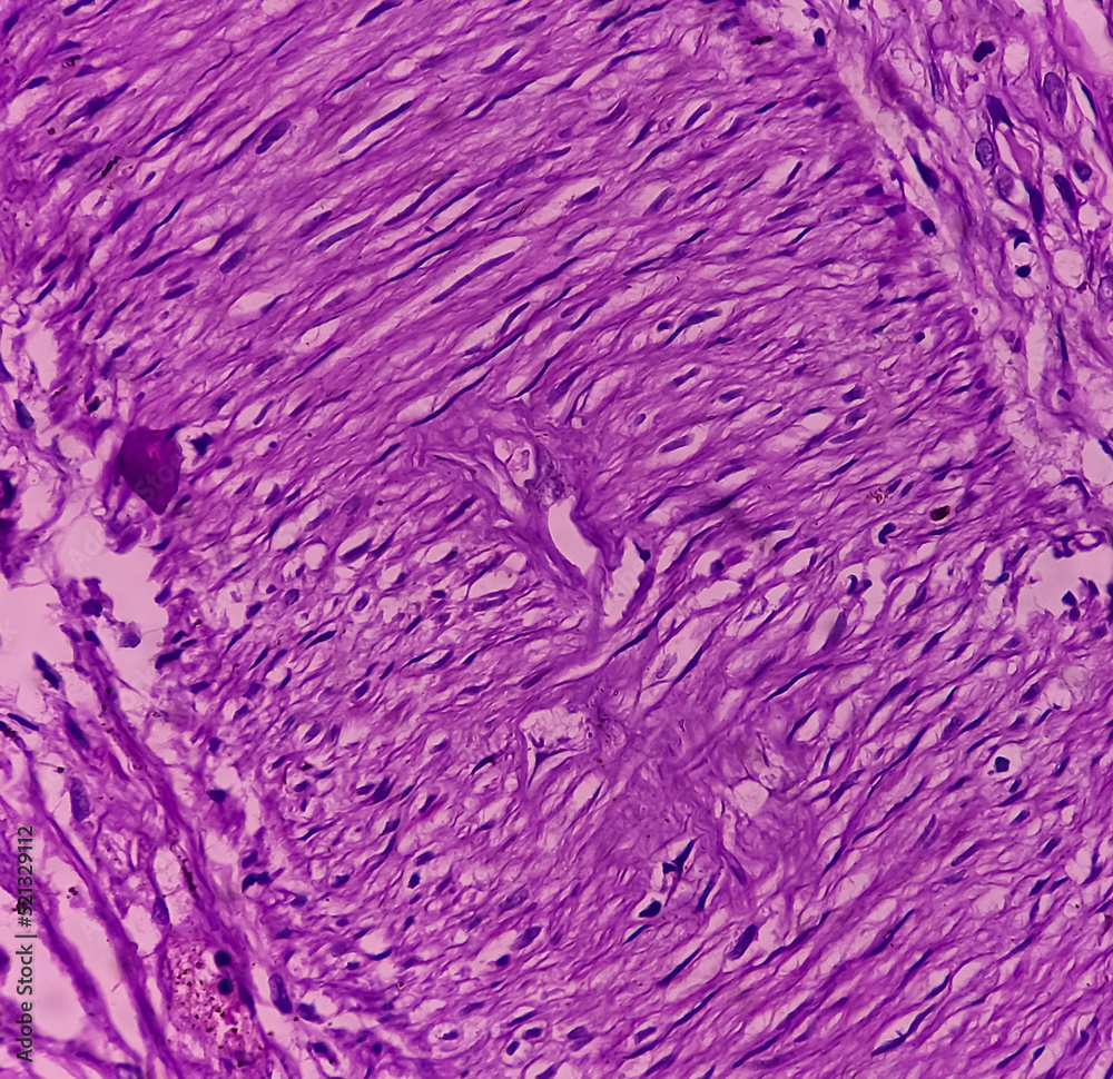 Sticker Dermoid cyst, Mature cystic teratoma, show skin, adnexal structure, fatty tissue, salivary acini and cartilage. Cystic teratoma of dermoid cyst.